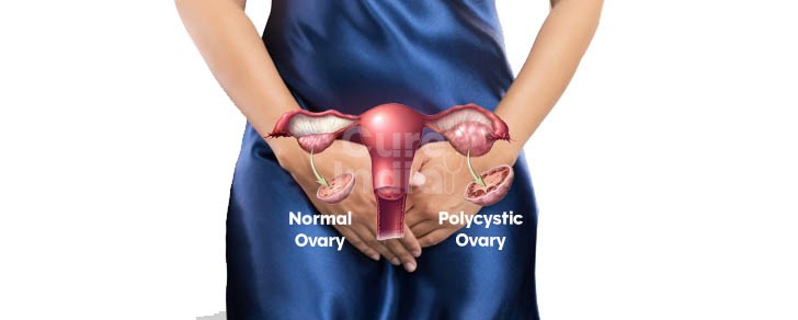 PCOS treatment in india
